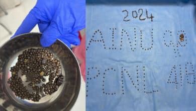 AINU removed 418 kidney stones from a 60-yr-old patient