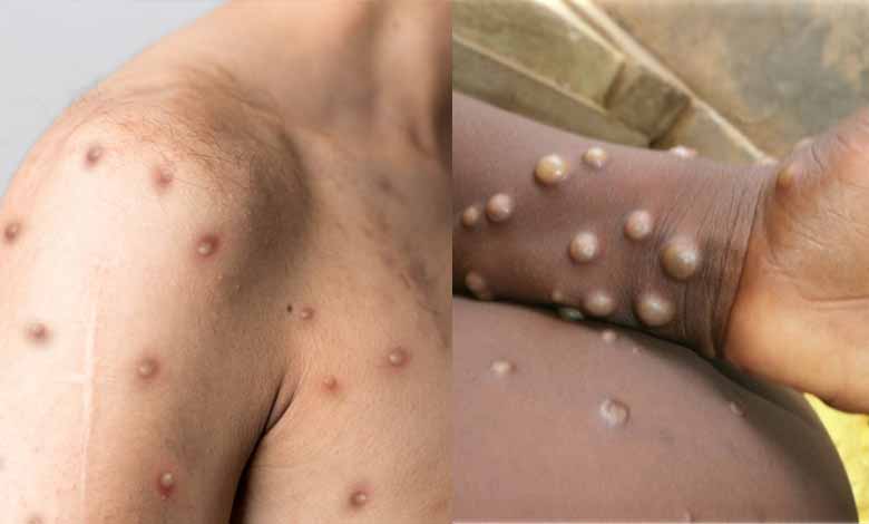 MPOX 2 Hyderabad on High Alert as WHO Declares Mpox a Global Health Emergency