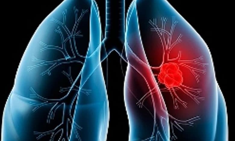 lungs 1 Study Reveals Ozone Therapy as Promising Treatment for Sepsis-Induced Lung Injury