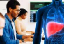 Health Crisis: 84% of Hyderabad IT Employees Suffer from Fatty Liver, Bengaluru Sounds Alarm