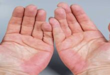 Fatty Liver Disease: 5 Early Warning Signs That Show Up on Your Hands