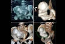 Viral Shock: 30-Year-Old Foetus Found in 73-Year-Old Woman? Social Media Divided