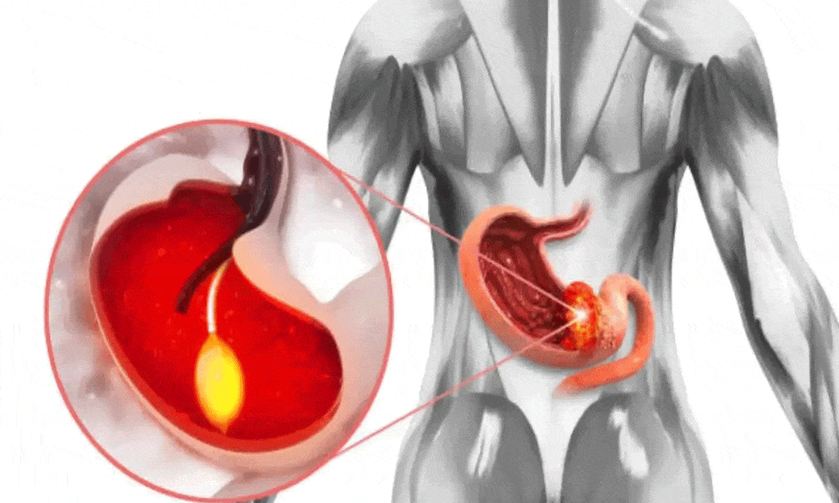 Morning Symptoms of Stomach Cancer You Should Never Ignore